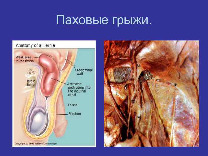 Паховые грыжи. 