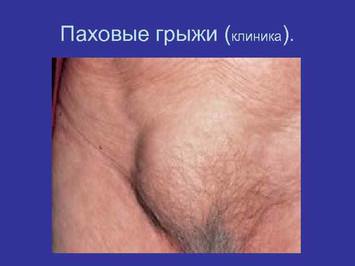 Паховые грыжи (клиника). 