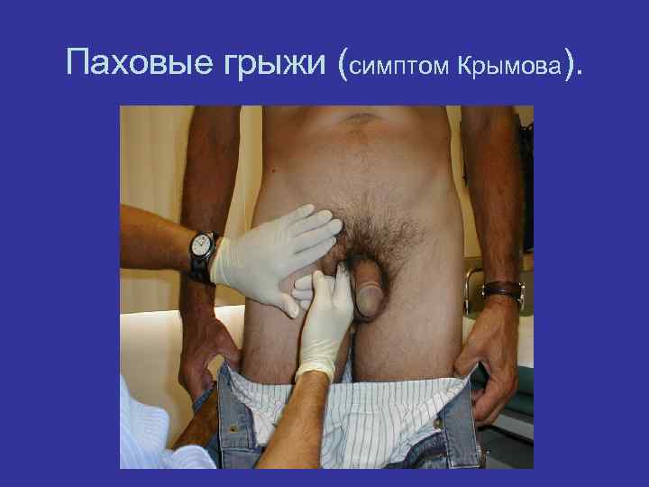 Паховые грыжи (симптом Крымова). 