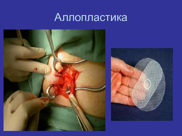 Аллопластика 