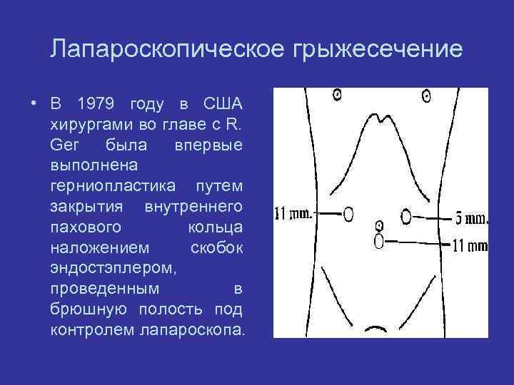 Лапароскопическое грыжесечение • В 1979 году в США хирургами во главе с R. Ger