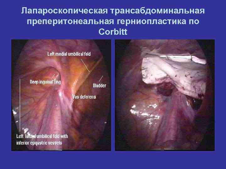 Лапароскопическая трансабдоминальная преперитонеальная герниопластика по Corbitt 