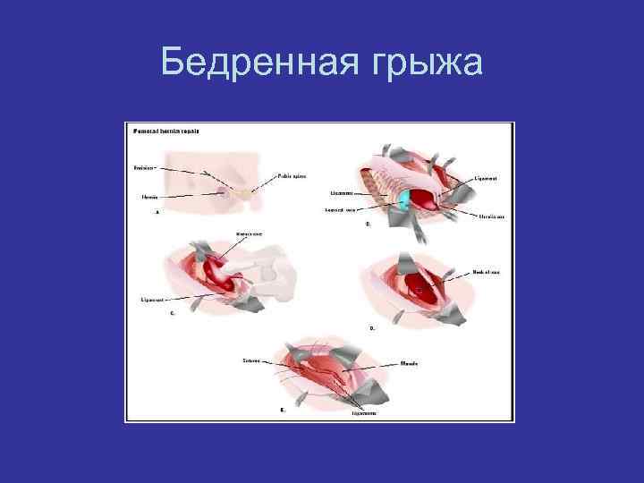 Бедренная грыжа 