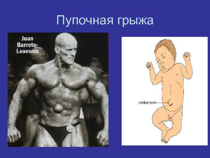 Пупочная грыжа 