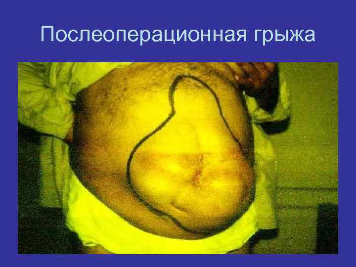 Послеоперационная грыжа 