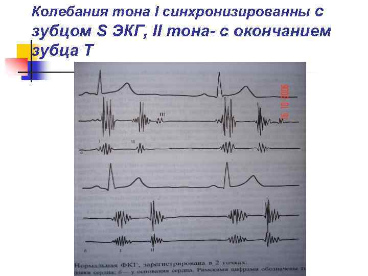 Колебания тона I синхронизированны с зубцом S ЭКГ, II тона- с окончанием зубца Т