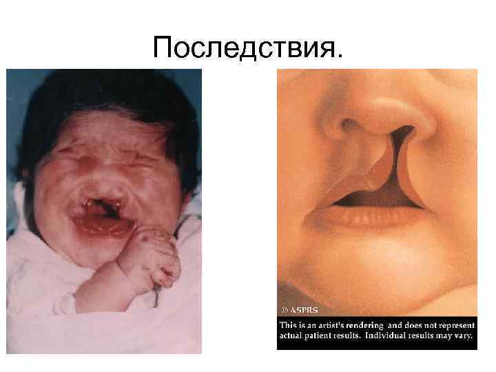 Последствия. 