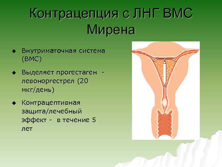 Контрацепция с ЛНГ ВМС Мирена u Внутриматочная система (ВМС) u Выделяет прогестаген левоноргестрел (20