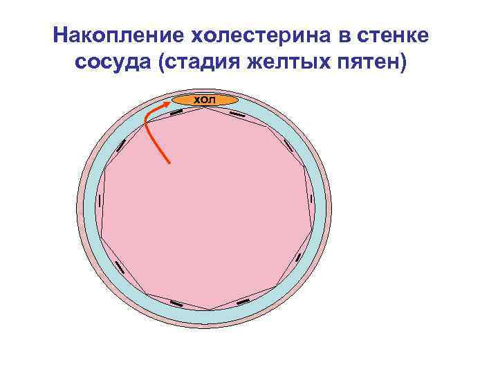 Накопление холестерина в стенке сосуда (стадия желтых пятен) хол 