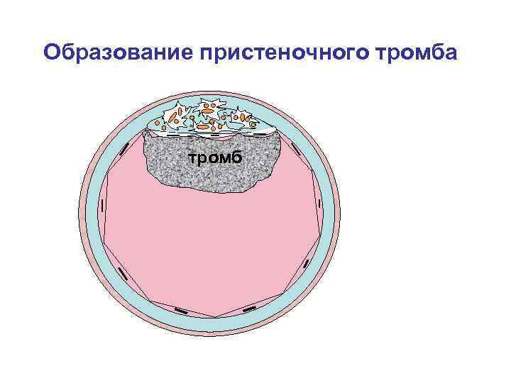 Образование пристеночного тромба тромб 