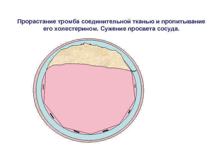 Прорастание тромба соединительной тканью и пропитывание его холестерином. Сужение просвета сосуда. 