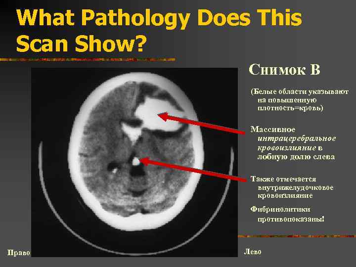 What Pathology Does This Scan Show? Снимок B (Белые области указывают на повышенную плотность=кровь)