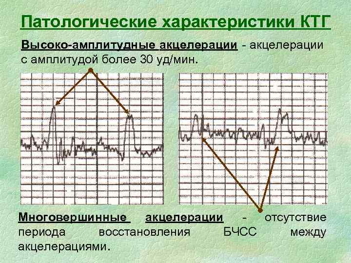 Патологические характеристики КТГ Высоко-амплитудные акцелерации - акцелерации с амплитудой более 30 уд/мин. Многовершинные акцелерации