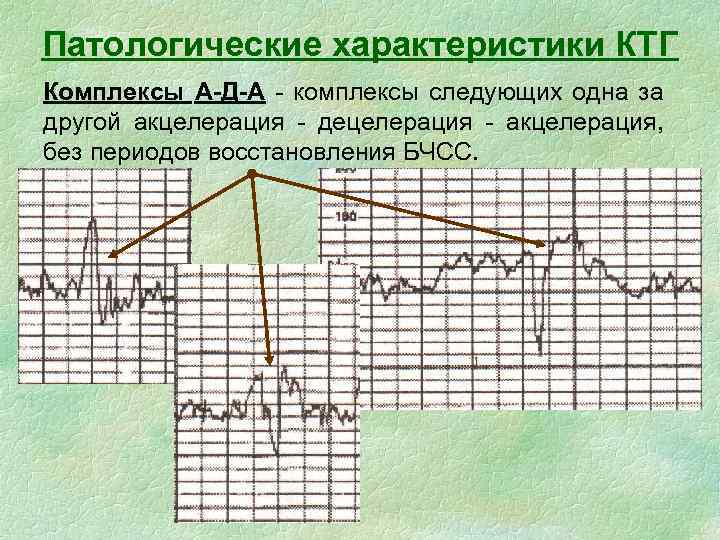 Патологические характеристики КТГ Комплексы А-Д-А - комплексы следующих одна за другой акцелерация - децелерация