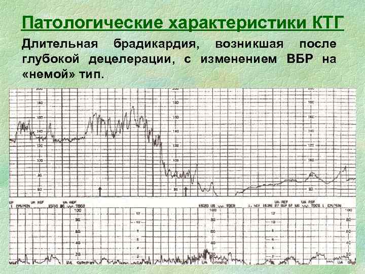 Сердцебиение плода на ктг