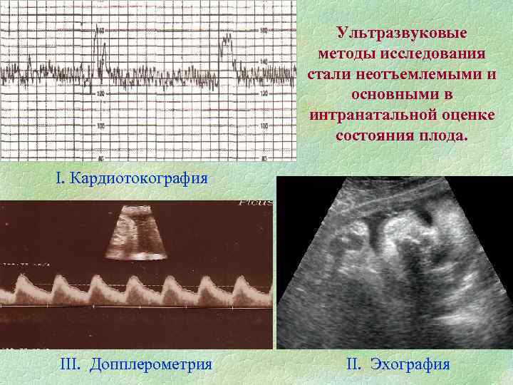 Ультразвуковые методы исследования стали неотъемлемыми и основными в интранатальной оценке состояния плода. I. Кардиотокография