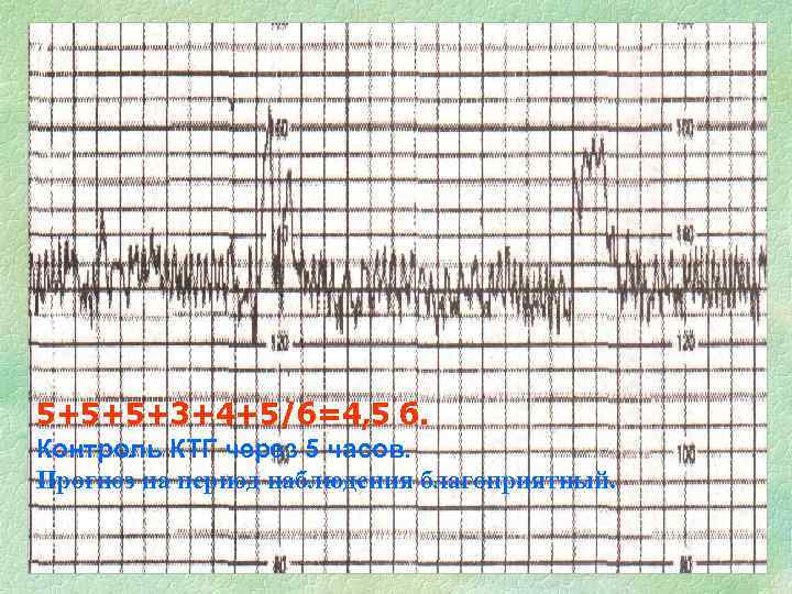 5+5+5+3+4+5/6=4, 5 б. Контроль КТГ через 5 часов. Прогноз на период наблюдения благоприятный. 