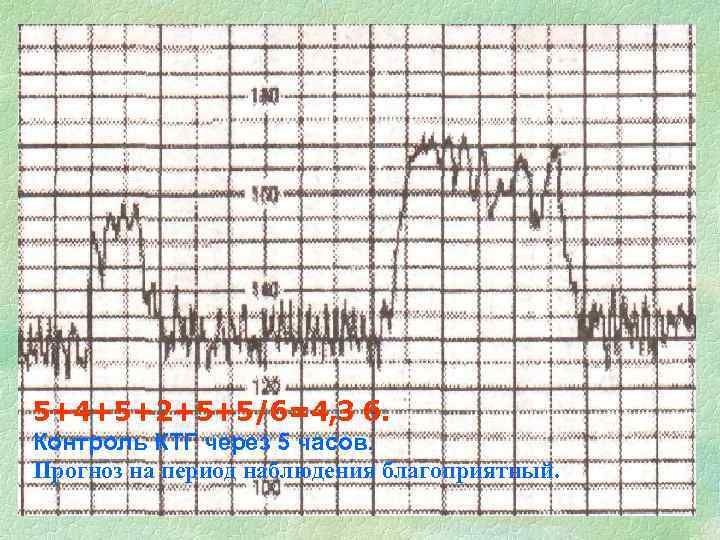 5+4+5+2+5+5/6=4, 3 б. Контроль КТГ через 5 часов. Прогноз на период наблюдения благоприятный. 