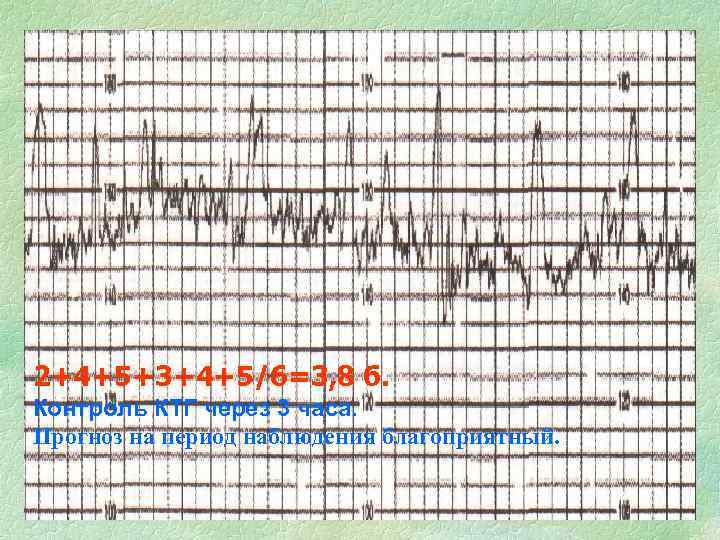 2+4+5+3+4+5/6=3, 8 б. Контроль КТГ через 3 часа. Прогноз на период наблюдения благоприятный. 