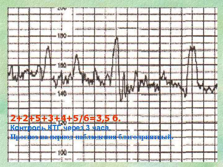2+2+5+3+4+5/6=3, 5 б. Контроль КТГ через 3 часа. Прогноз на период наблюдения благоприятный. 
