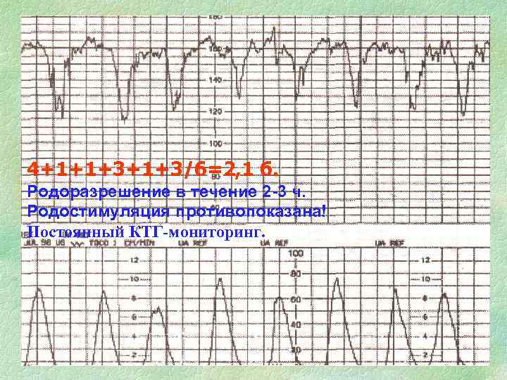 4+1+1+3/6=2, 1 б. Родоразрешение в течение 2 -3 ч. Родостимуляция противопоказана! Постоянный КТГ-мониторинг. 