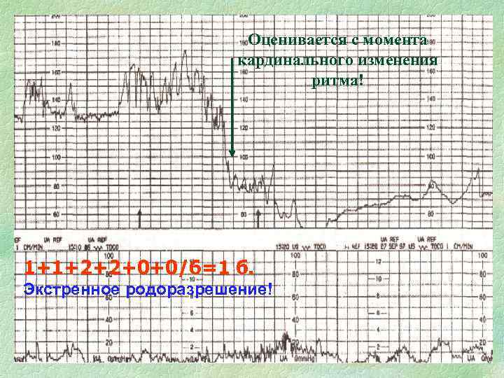 Оценивается с момента кардинального изменения ритма! 1+1+2+2+0+0/6=1 б. Экстренное родоразрешение! 