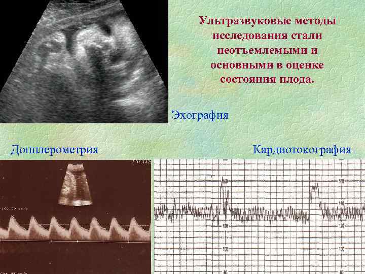 Ультразвуковые методы исследования стали неотъемлемыми и основными в оценке состояния плода. Эхография Допплерометрия Кардиотокография