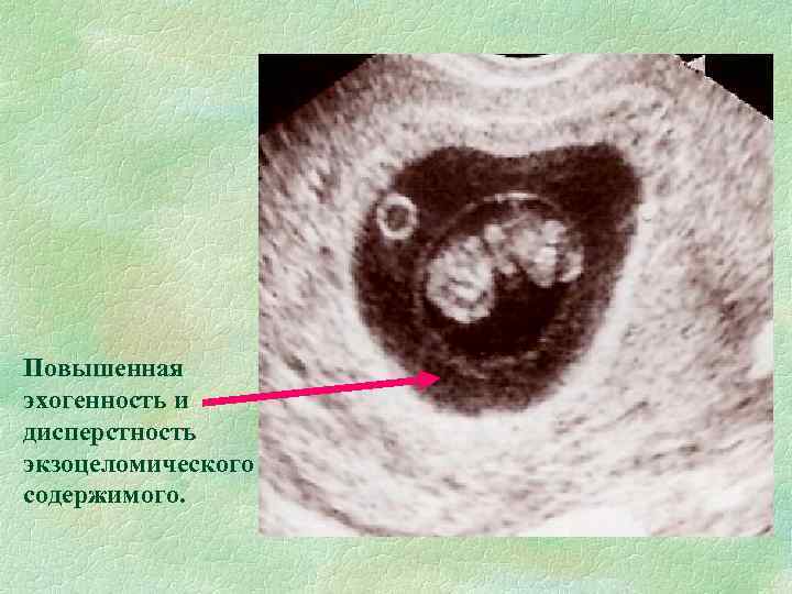 Повышенная эхогенность и дисперстность экзоцеломического содержимого. 