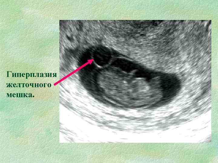 Гиперплазия желточного мешка. 