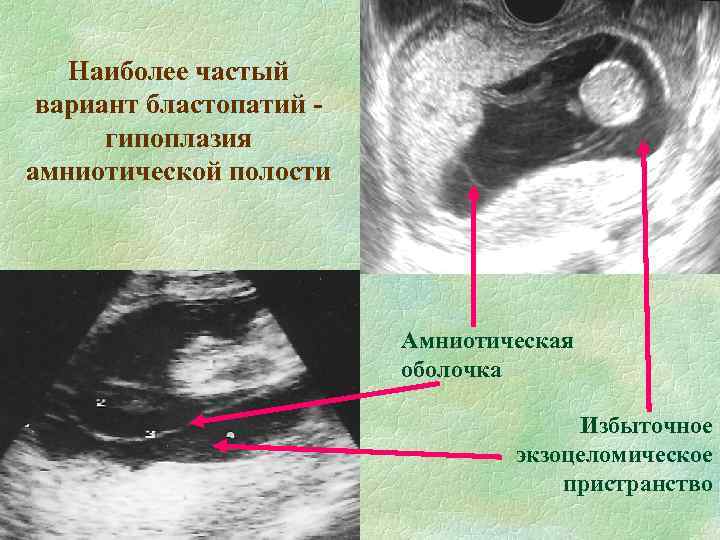 Наиболее частый вариант бластопатий гипоплазия амниотической полости Амниотическая оболочка Избыточное экзоцеломическое пристранство 