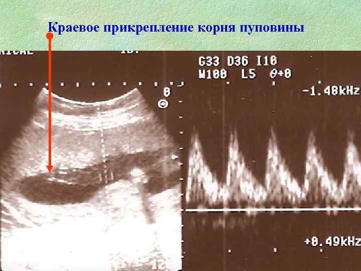Краевое прикрепление корня пуповины 