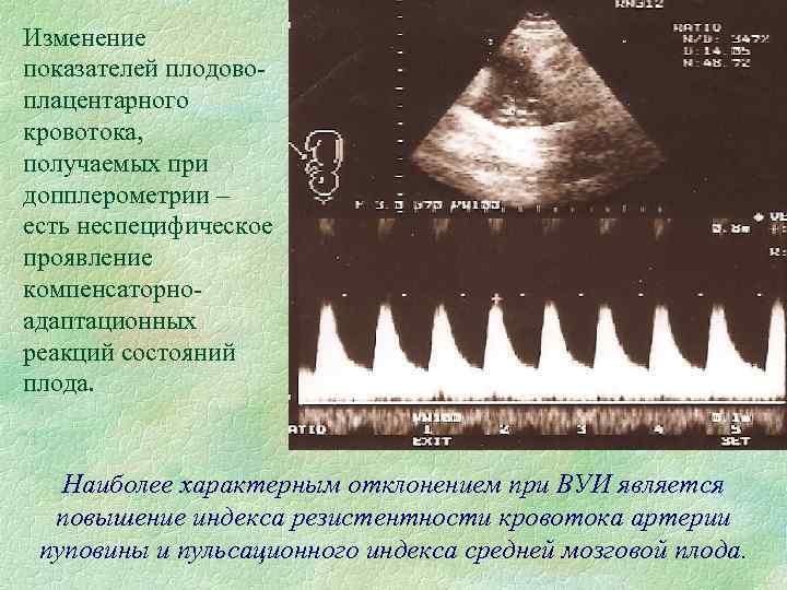 Изменение показателей плодовоплацентарного кровотока, получаемых при допплерометрии – есть неспецифическое проявление компенсаторноадаптационных реакций состояний