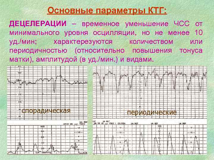 Ктг рисует схватки