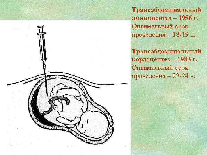 Трансабдоминальный амниоцентез – 1956 г. Оптимальный срок проведения – 18 -19 н. Трансабдоминальный кордоцентез