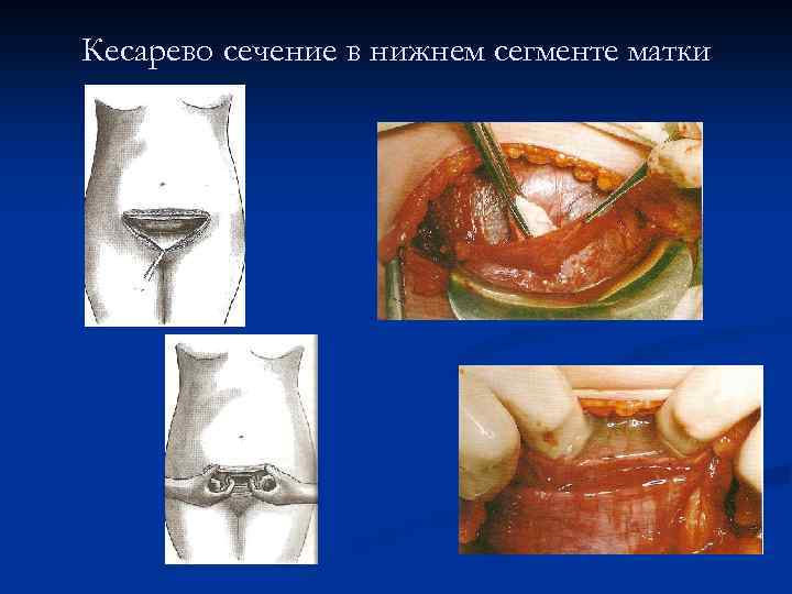 Кесарево сечение в нижнем сегменте матки 