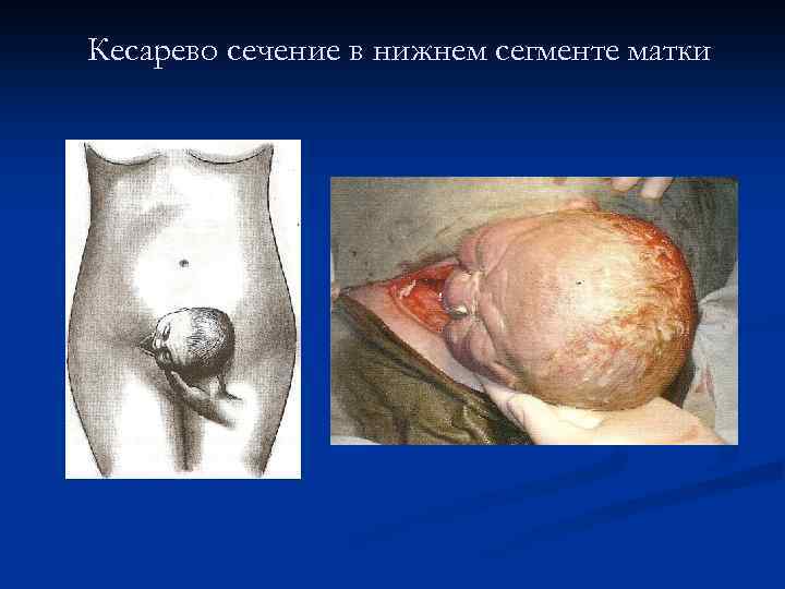 Кесарево сечение в нижнем сегменте матки 