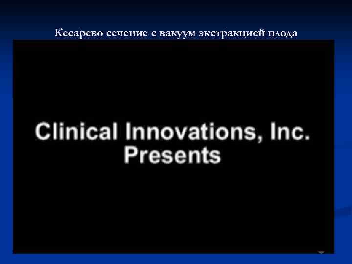 Кесарево сечение с вакуум экстракцией плода 