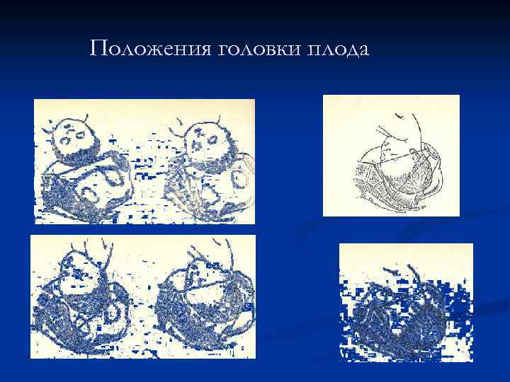 Положения головки плода 