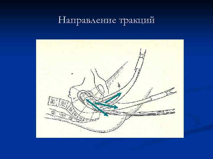 Направление тракций 