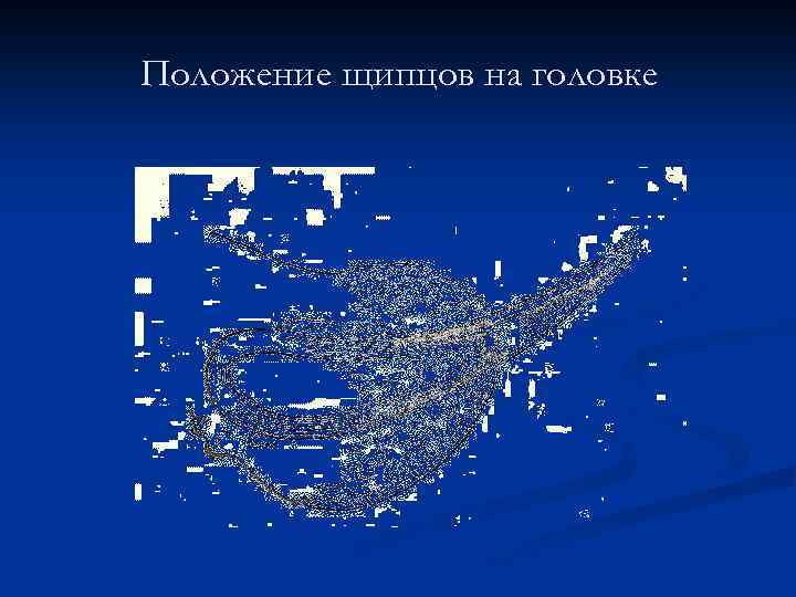 Положение щипцов на головке 