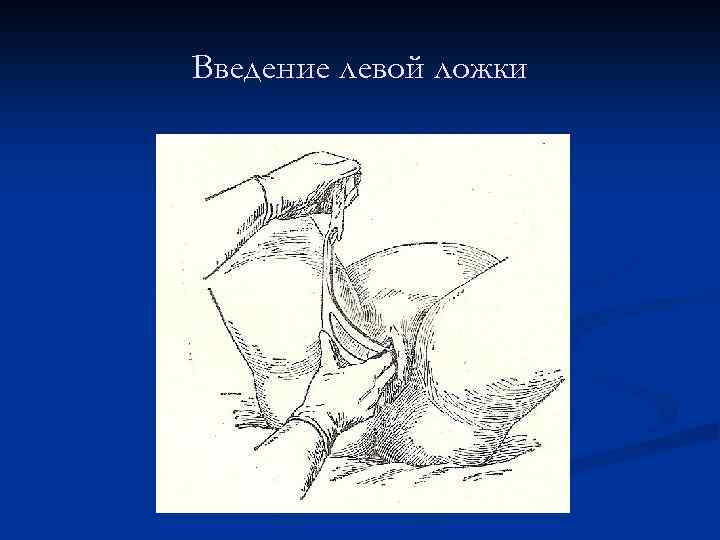 Введение левой ложки 