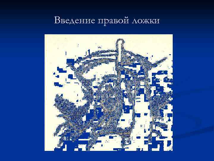 Введение правой ложки 
