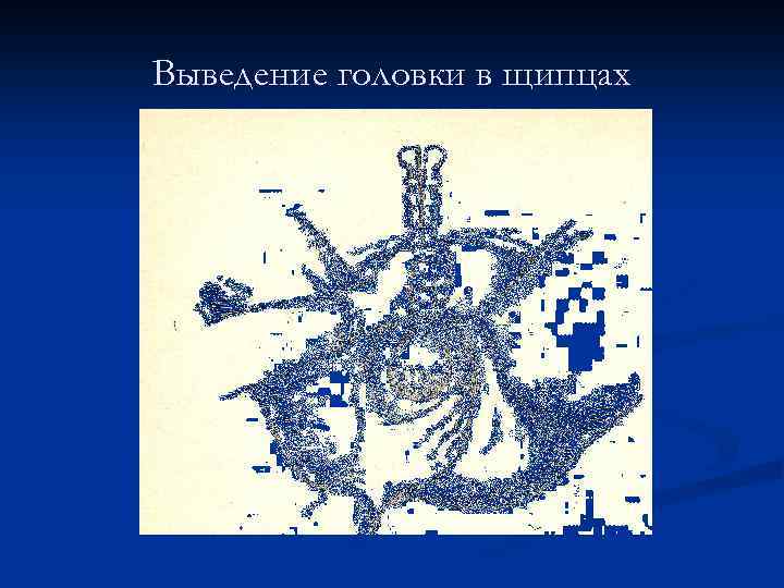 Выведение головки в щипцах 