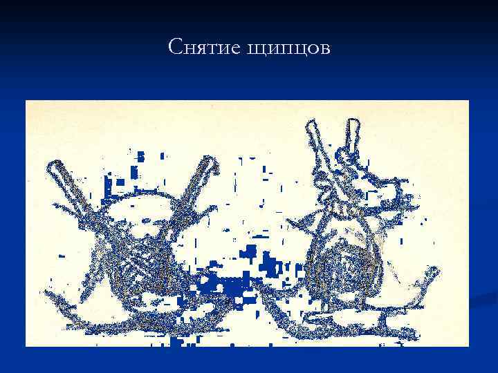 Снятие щипцов 