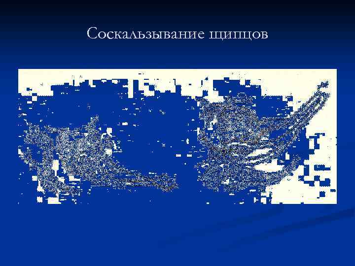 Соскальзывание щипцов 