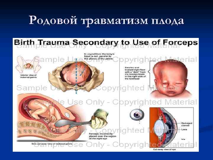 Родовой травматизм плода 