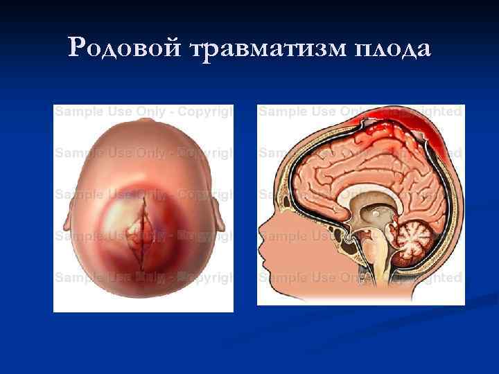 Родовой травматизм плода 