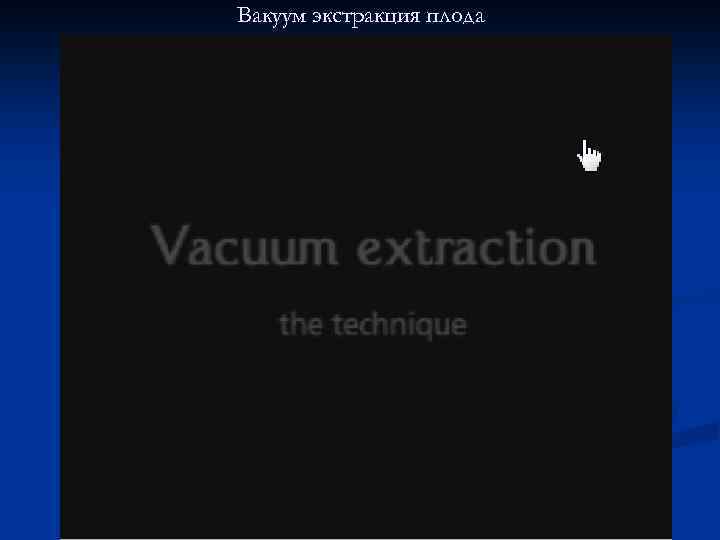 Вакуум экстракция плода 