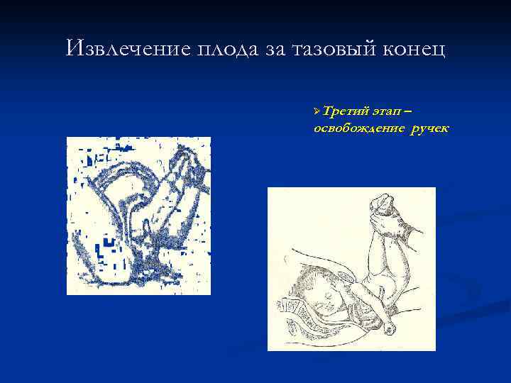 Извлечение плода за тазовый конец ØТретий этап – освобождение ручек 