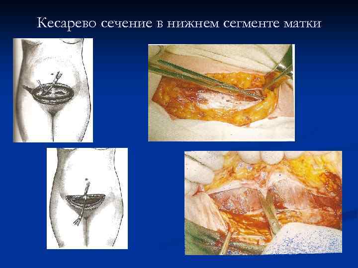 Кесарево сечение в нижнем сегменте матки 